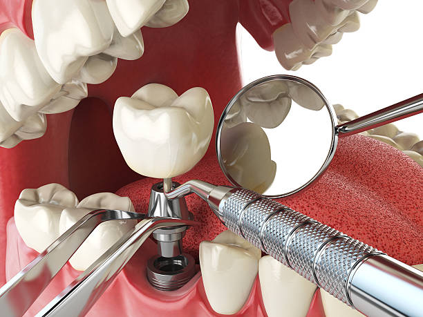 Best Broken or Chipped Tooth Repair in Brookhaven, PA